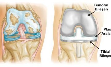 Diz Protez Ameliyatı