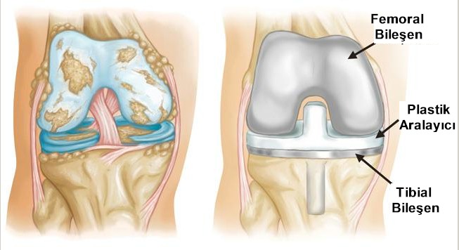 Diz Protez Ameliyatı